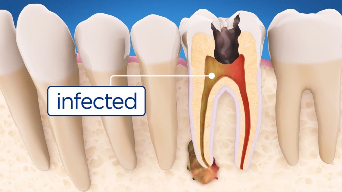 Root Canal Therapy