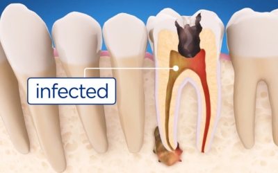Root Canal Therapy